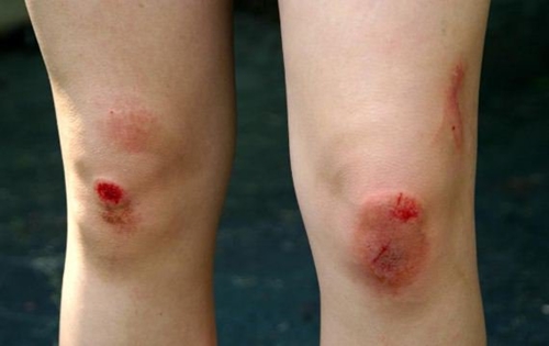 Cách xử lý vết thương té xe trầy chân nữ không để lại sẹo